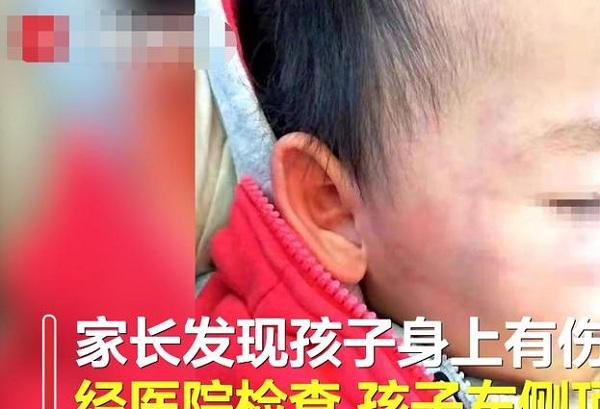 如何看待贵阳一2岁男童遭老师狂扇耳光致头部骨折教师醉酒打人致骨折怎么处理教师醉酒打人致骨折